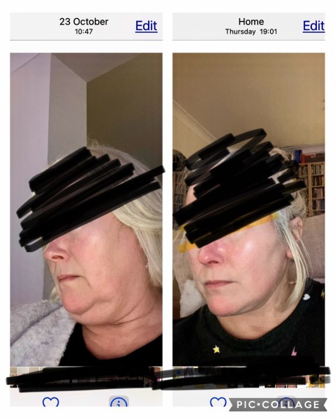 Does anyone want to come on my Upper and Lower Bleph and Necklift journey with me?