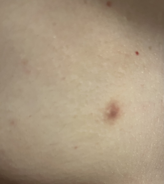 Breast lump - worrying for nothing?