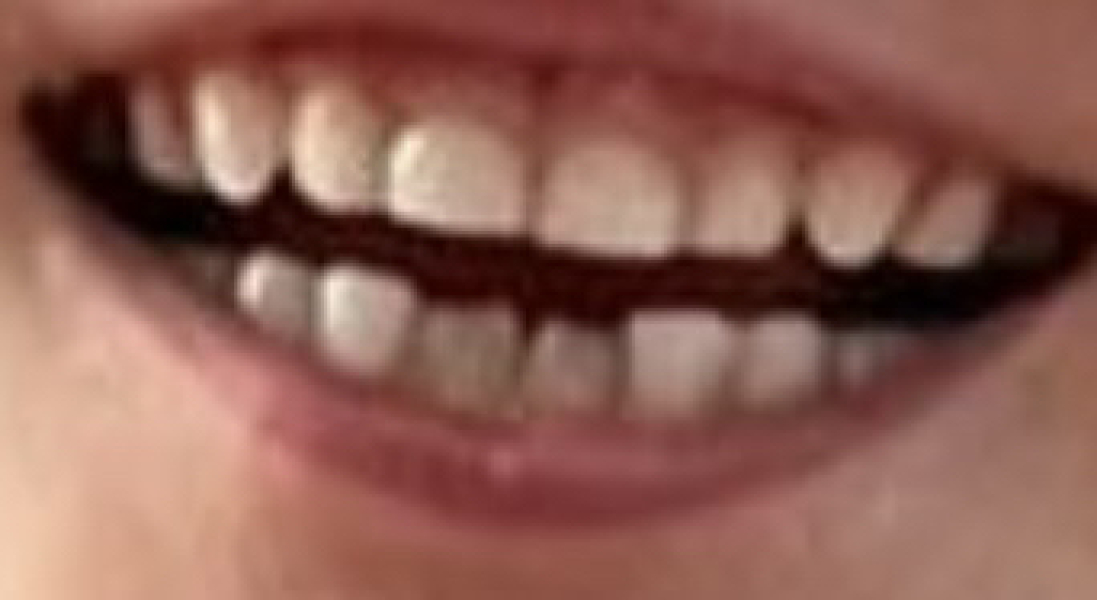 Worried about adult tooth coming through