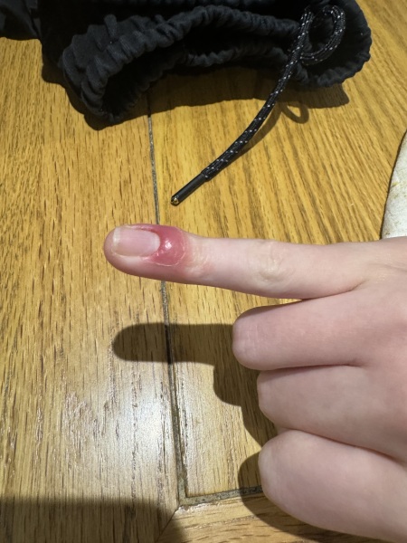 Infected finger?