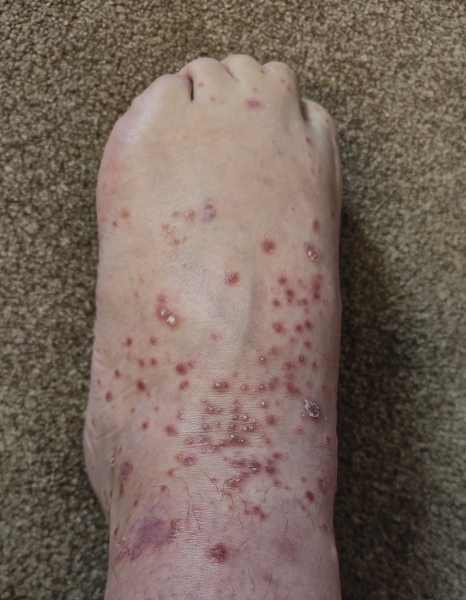 Hand, foot and mouth plus psoriasis