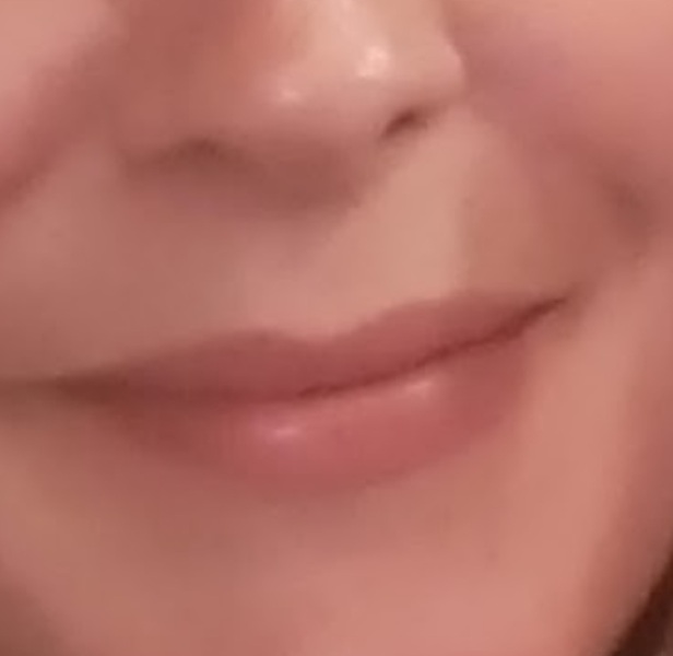 What is with lip fillers?!? They look so fake and awful