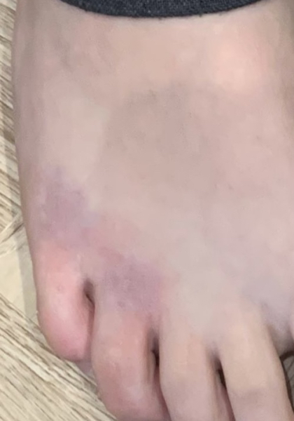 To not take son to a&e with a suspected broken toe?