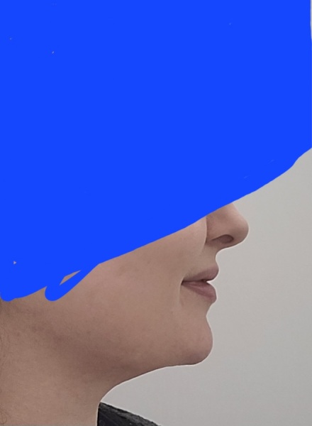 What is with lip fillers?!? They look so fake and awful