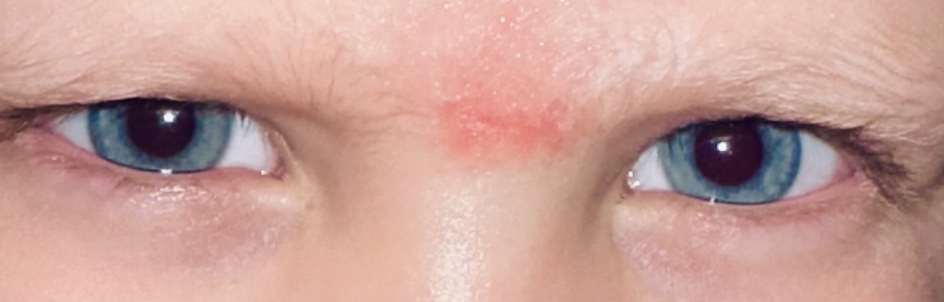 Help! Scar on my LO's face