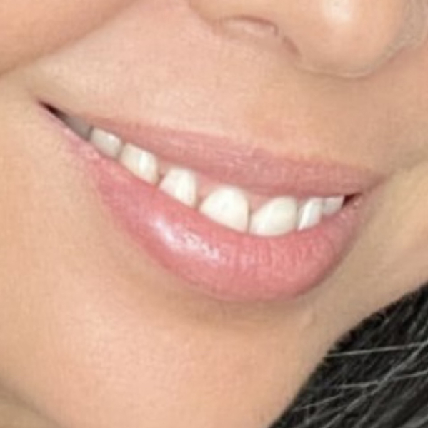 Lip filler everywhere