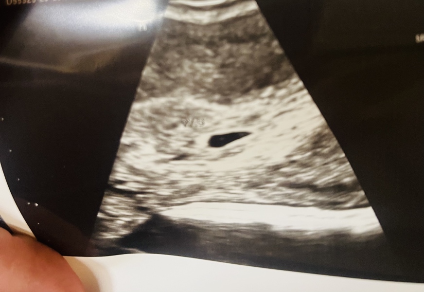 Anyone early scan help