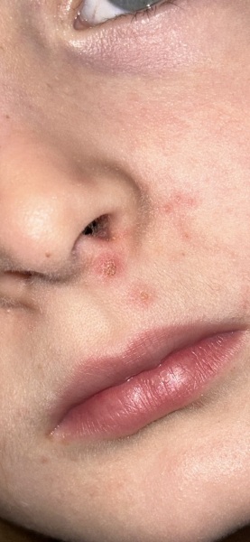 Impetigo?