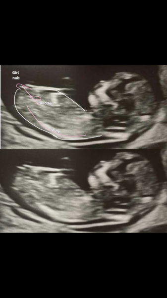 Nub or umbilical cord ?