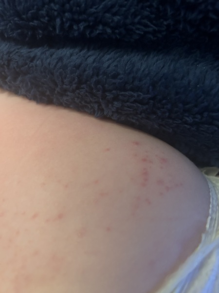What is this rash?