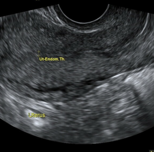 Gyno issues