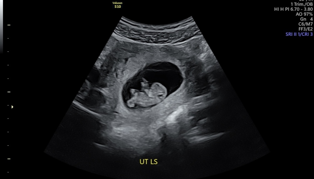 Scans at 8.5-10.5 weeks what could you see ?
