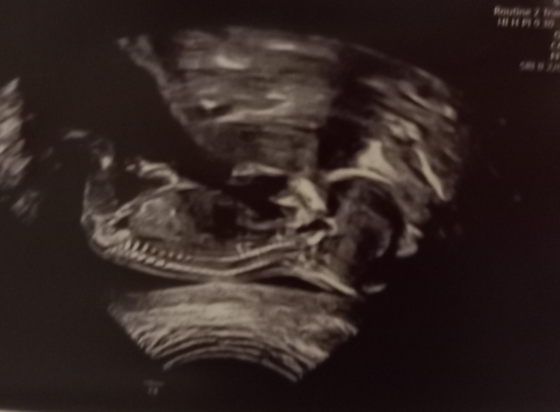 Show me you 12w scan. Am bored and want to test my nub theory 😁