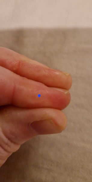 Lancet finger blood test