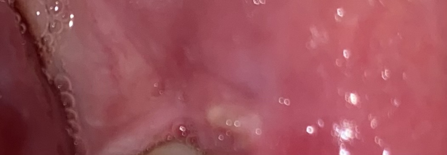 Gum abbess or ulcer?