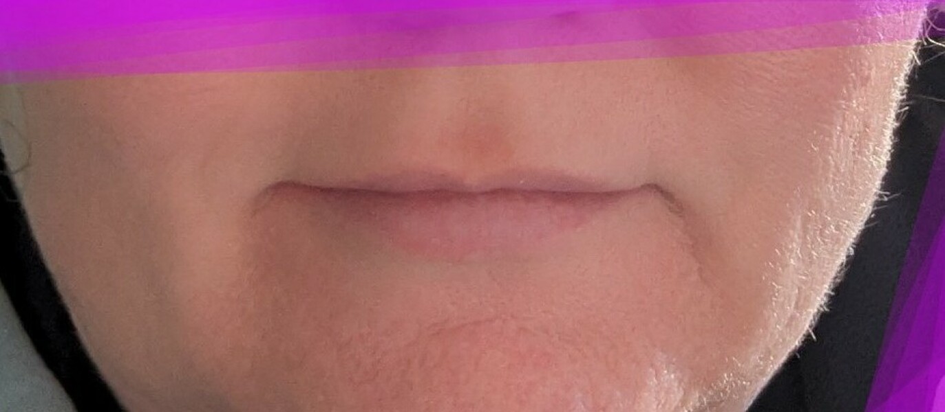 What is with lip fillers?!? They look so fake and awful