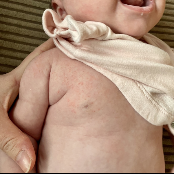 CMPA or Eczema