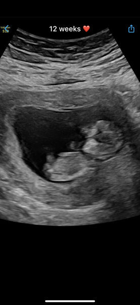 Early pregnancy scan pic…. Boy or girl?