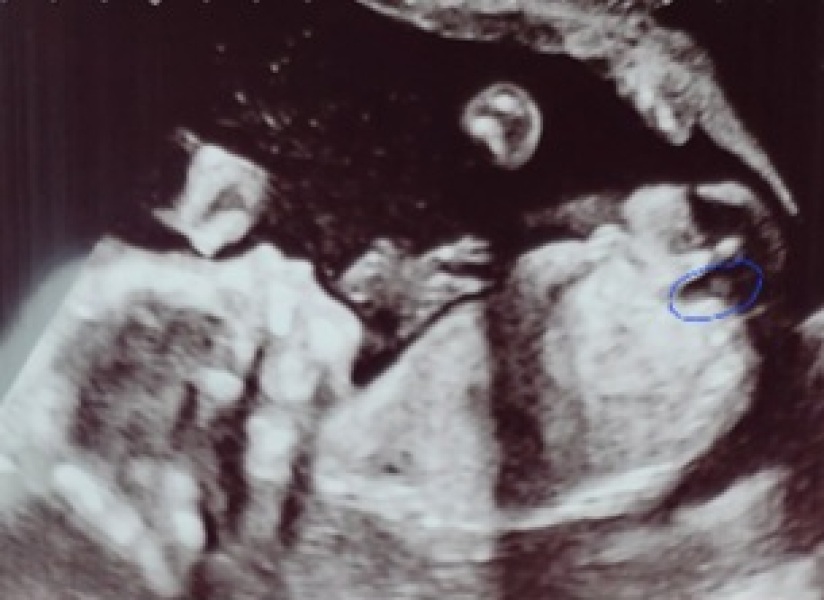 Cord or penis on scan?!
