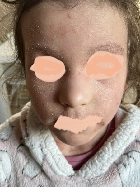 Please someone help me with my daughters skin