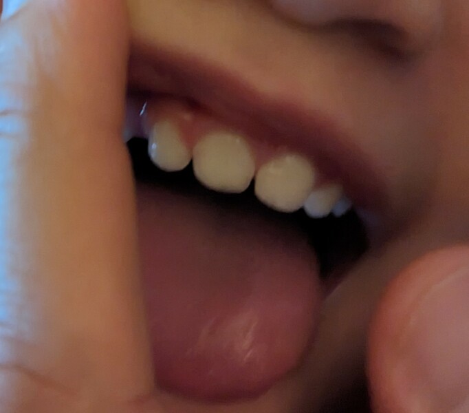 Baby split gum - Advice please (pics)
