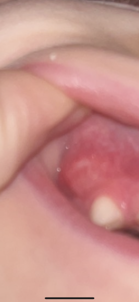 What is this on my child’s gum?