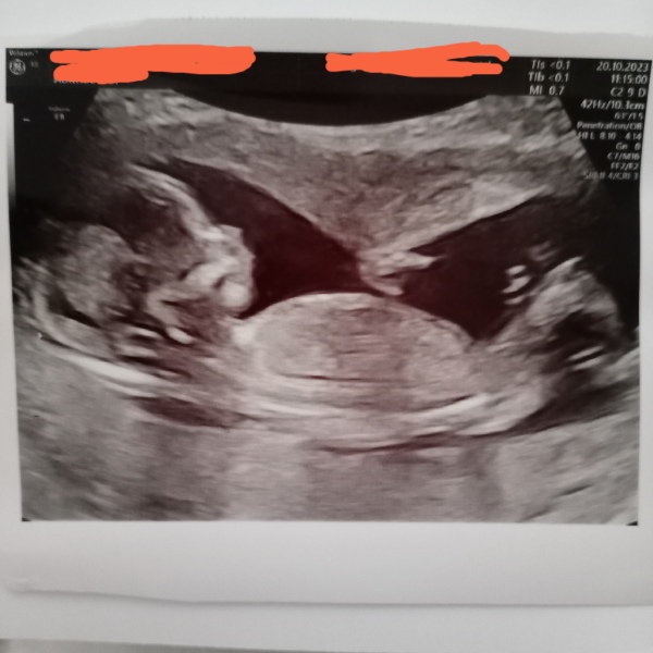 Boy or girl 🥰