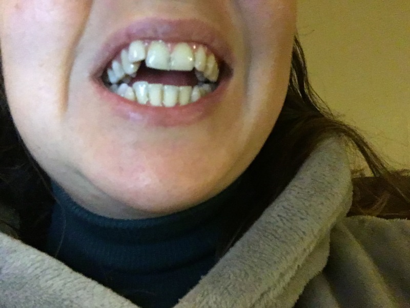 Open bite correction