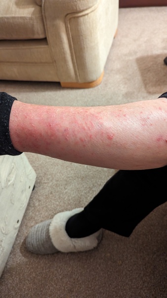 93 yr old granny suddenly has really bad dermatitis /crusty - moles appearing. Photos