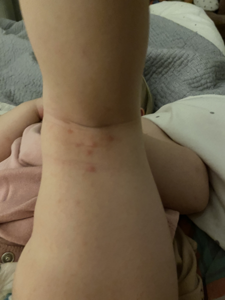 Is this chicken pox or HFM please?