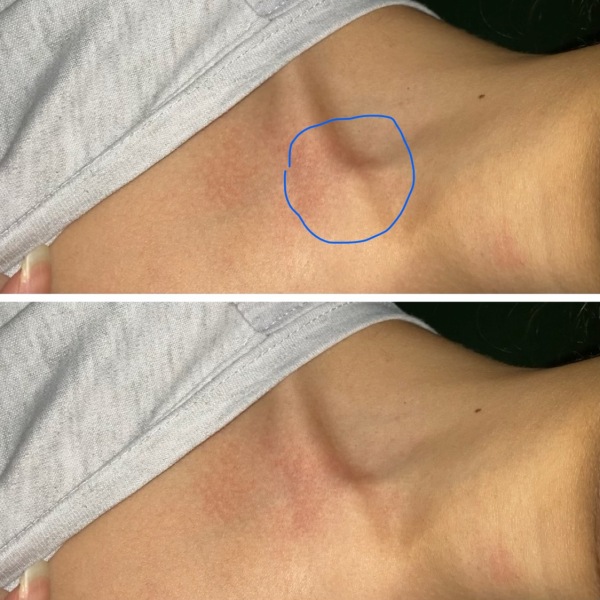 Does my collarbone look like a bulge? Or I am delusional r/AskDoctorSmeeee - Does my collarbone look like a bulge? Or I am delusional r/AskDoctorSmeeee - Does my collarbone look like a bulge? Or I am delusional