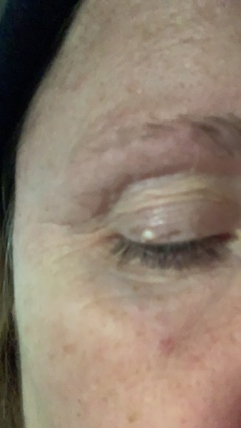 Eyelid blemish