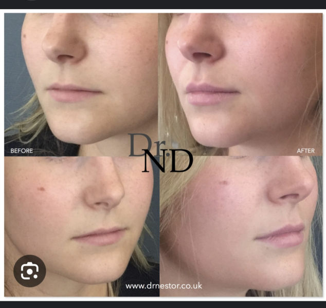 Lip filler everywhere