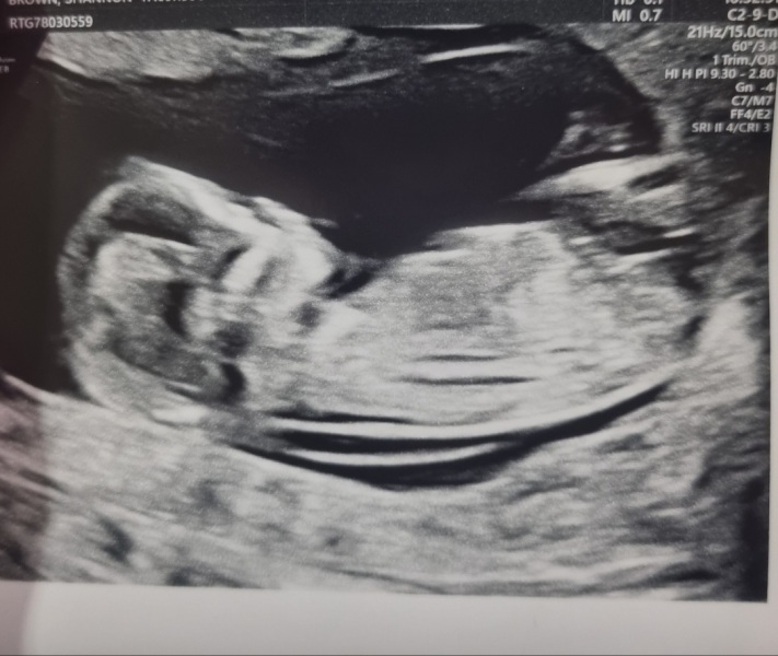 Nub theory - i have my 20 week scan tomorrow