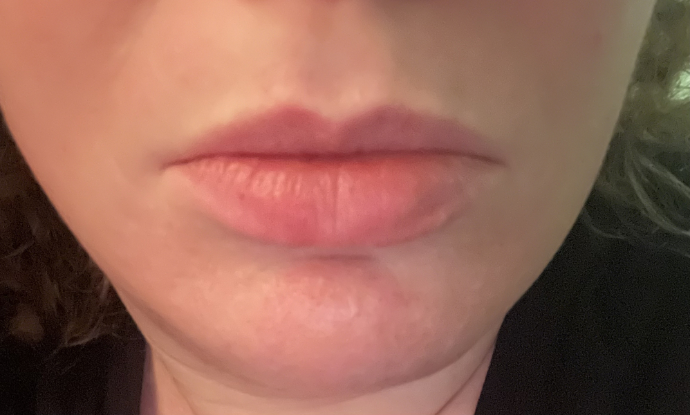 Lip filler everywhere