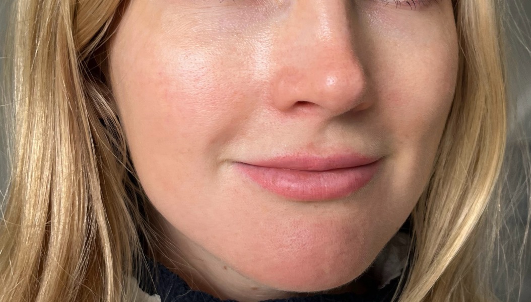 What is with lip fillers?!? They look so fake and awful