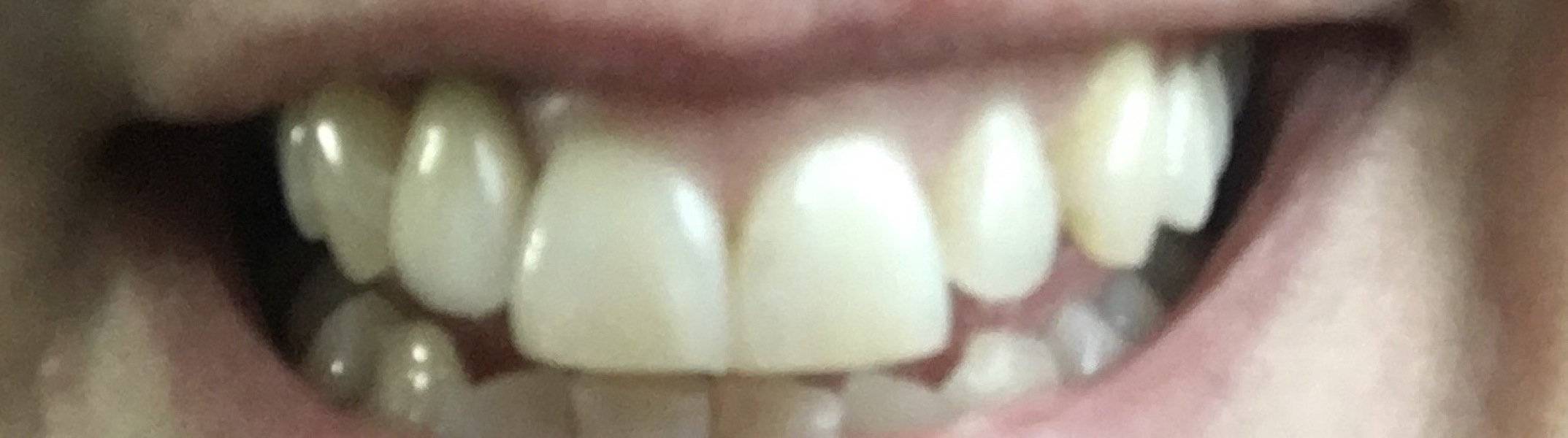 Dental Implant?