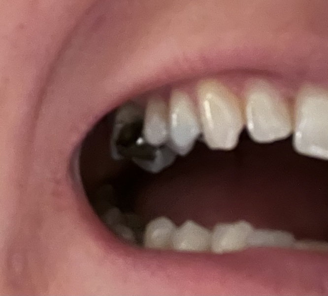 Any dentists about please? I’ve broken a tooth