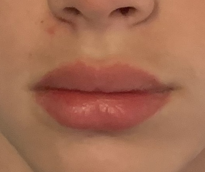 What is with lip fillers?!? They look so fake and awful