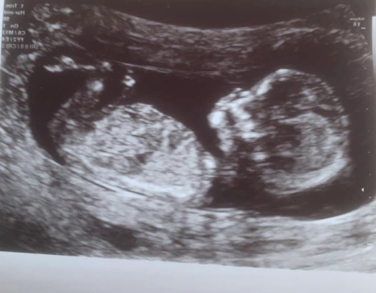Boy or girl scan