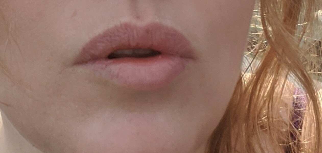 Lip filler everywhere