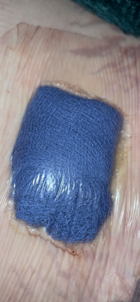 Gallstone removal wounds / dressings - help