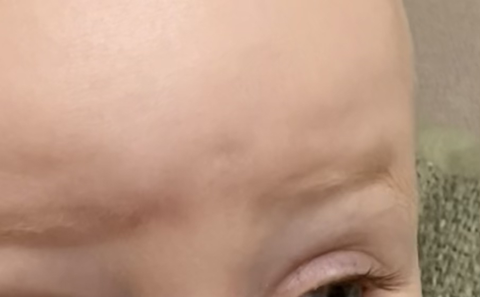 My baby dented her forehead on the skirting board. I am so upset. Pic included.