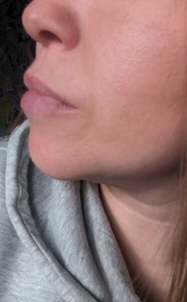 What is with lip fillers?!? They look so fake and awful