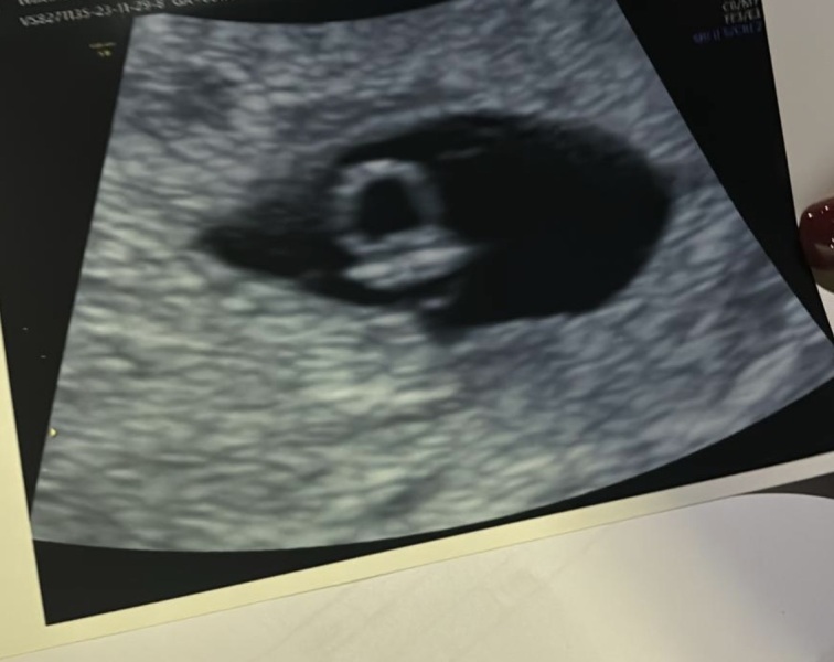 6 week scan