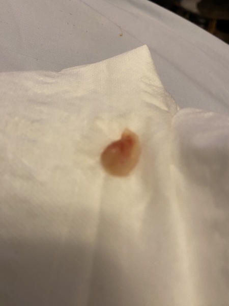 Nasal polyp?