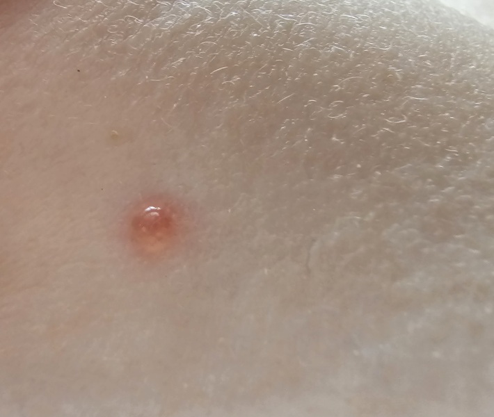 Would you say start of chicken pox? pic! how did it start for yours?