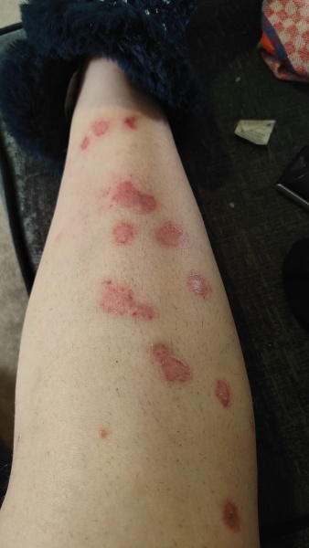 Hand, foot and mouth plus psoriasis