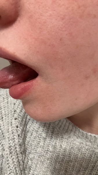 White patch on inner cheek and tongue