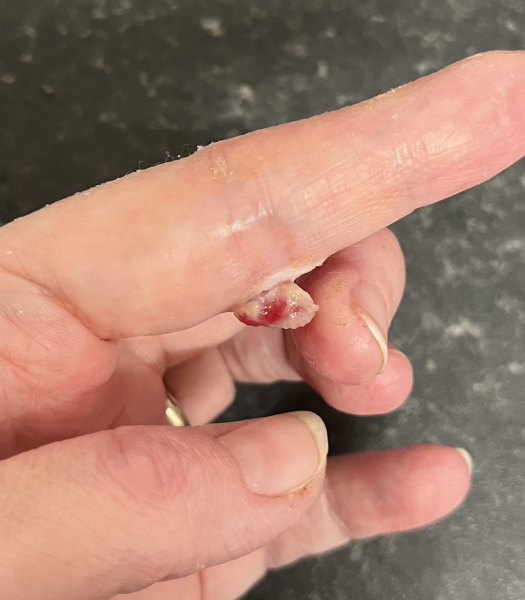 What is this lump?